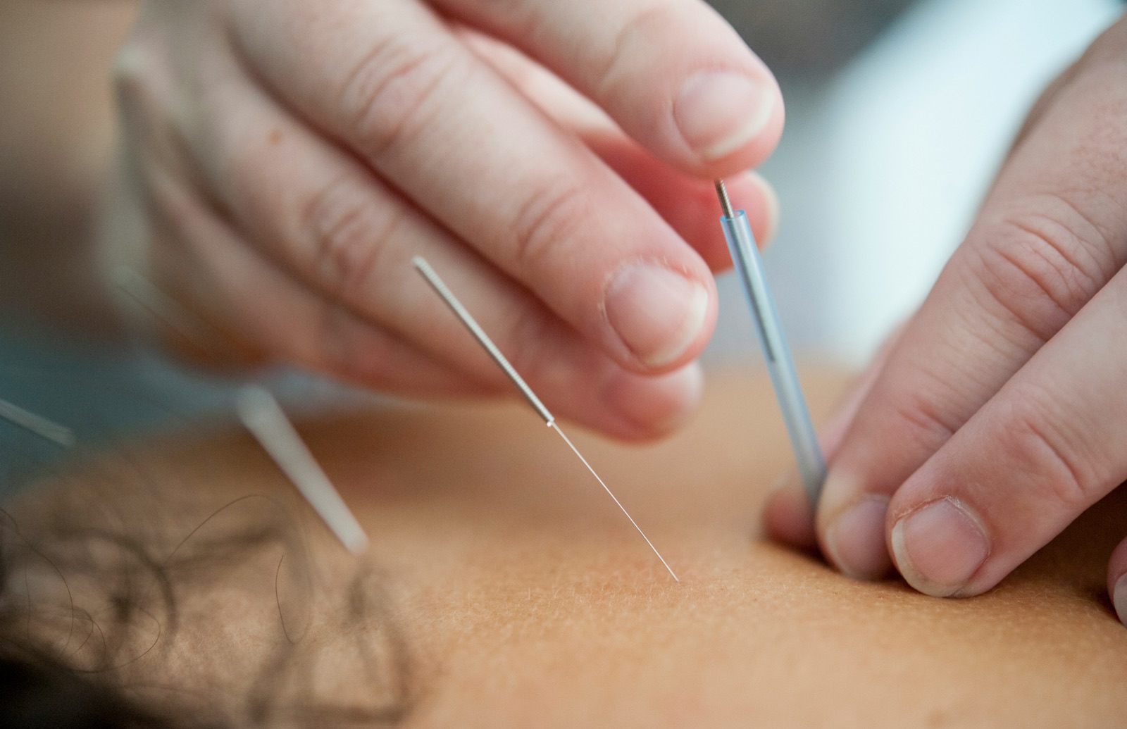 Pose d'une aiguille d'acupuncture sur la peau